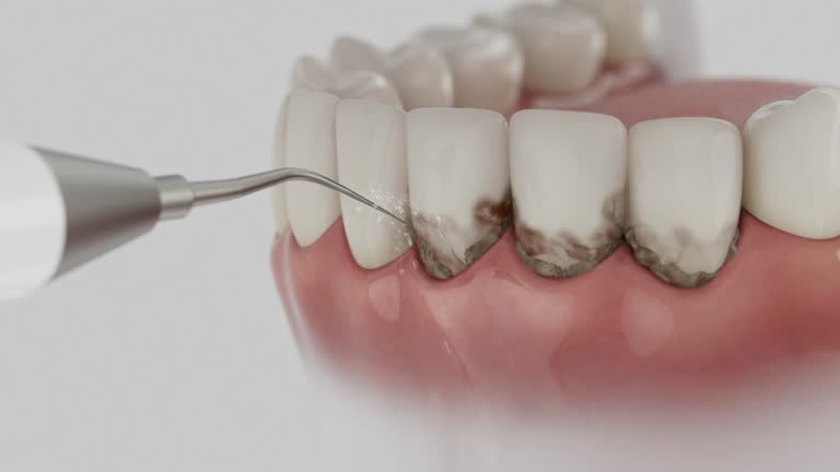 Trusted Wisdom Tooth Removal service in Atlantic Beach, FL - Dentist Open Now